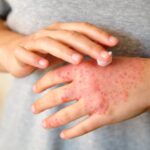 Eczema in Winter: Tips for Relief