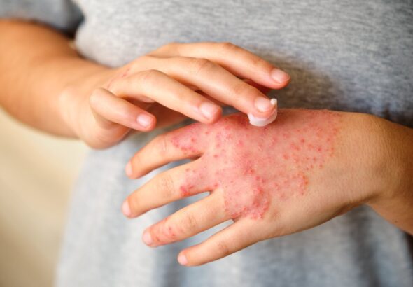 Eczema in Winter: Tips for Relief